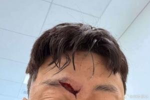 慎入！高准翼眉骨处裂开一道大口子，比赛中头部相撞赛后已缝针 配图