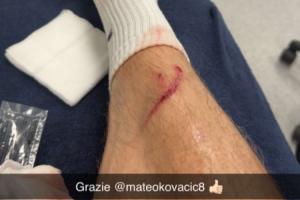 误伤自己人！哈兰德晒照：训练中小腿被科瓦契奇踢出一道血痕 配图