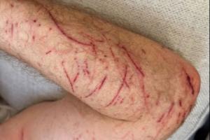 55岁希勒骑自行车时受伤：手臂、腿部多处割伤和擦伤 配图